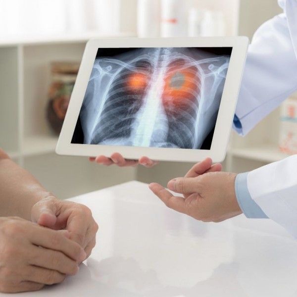 Pnömokonyoz (ILO tarfından sertifikalı Pnömokonyoz okuyucuları tarafından; Tek-Çift okuyucu)